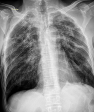 CASIA-CXR